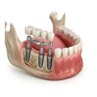 کاربرد تیتانیوم در پزشکی